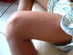 Allergiák természetes kezelése – Allergiásoknak 5 percben